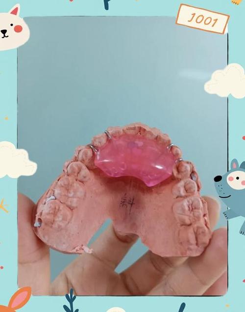 矫正牙齿戴导板，究竟有什么作用？-图1