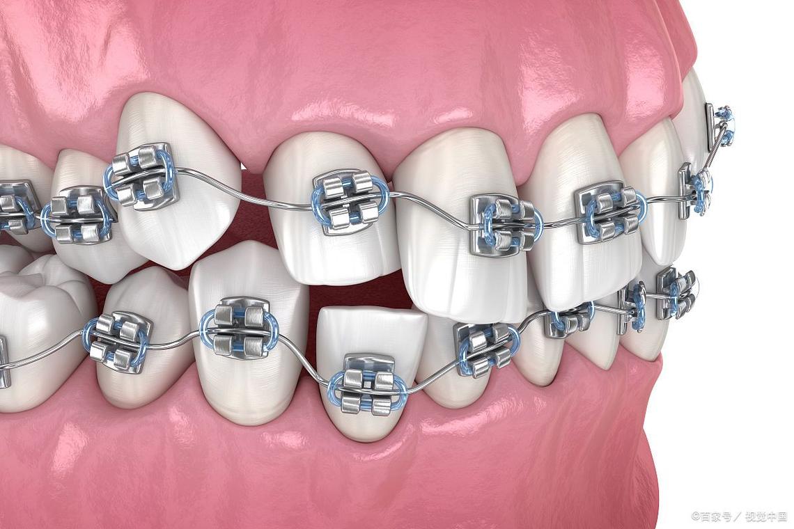 闭锁合牙齿矫正效果如何？矫正难点有哪些？-图2