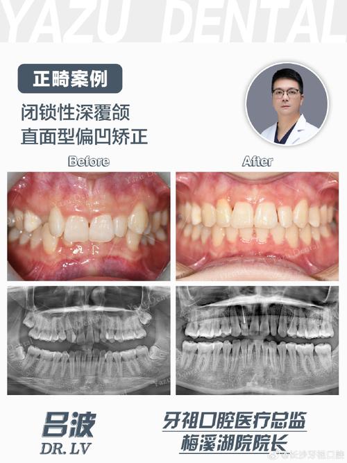 闭锁合牙齿矫正效果如何？矫正难点有哪些？-图3