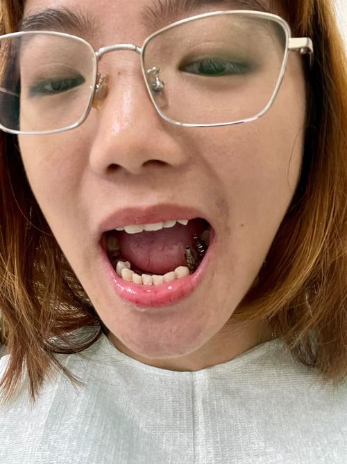 牙齿矫正后种牙，时机、效果和注意事项有哪些？-图1