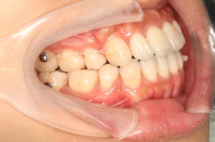 兰州市牙齿矫正-图2