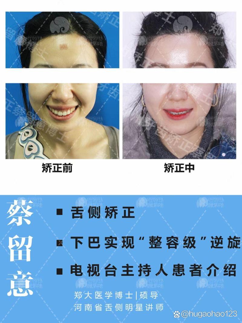 郑州牙齿矫正怎么选？医院靠谱、价格效果如何？-图2