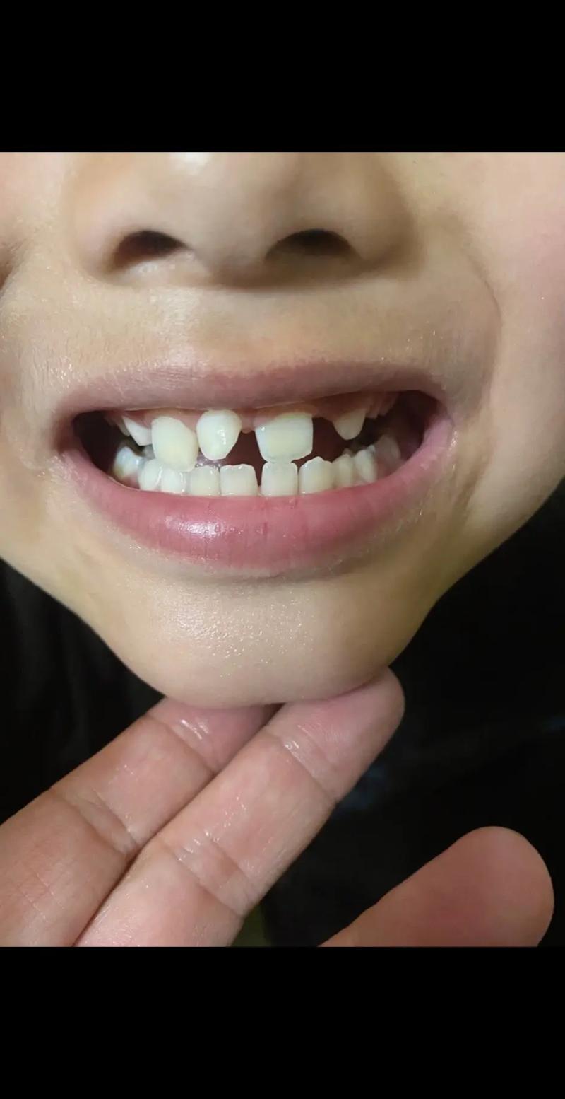 牙齿矫正门牙歪，是矫正器选错还是术后护理没到位？-图1