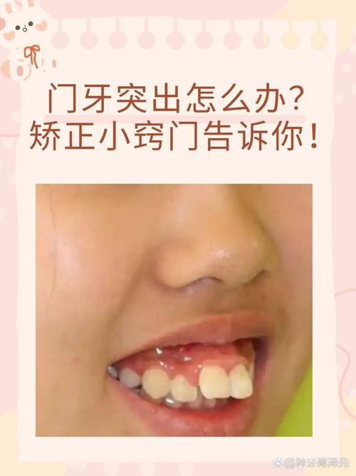 牙齿矫正门牙歪，是矫正器选错还是术后护理没到位？-图3