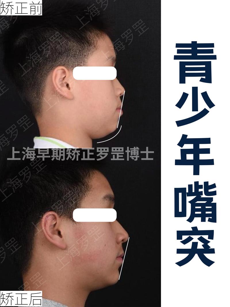 矫正牙齿后嘴变凸，是矫正方式问题还是必然结果？-图2