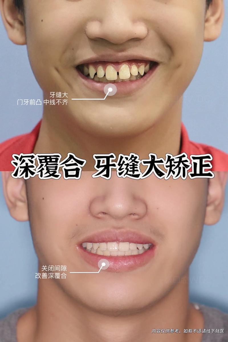 牙齿间隙大矫正-图3