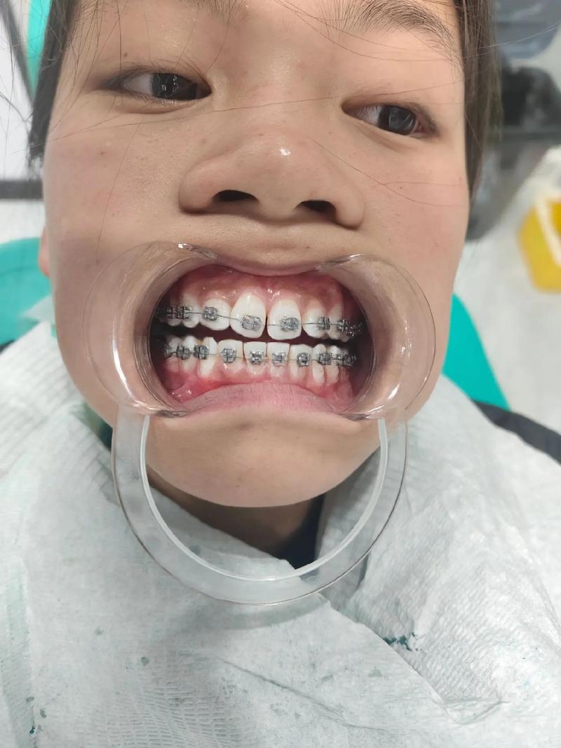 中学生矫正牙齿，家长和学生必知的矫正时机与注意事项有哪些？-图3