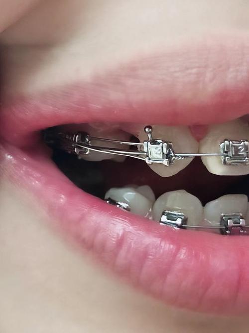 牙齿矫正为何要关缝隙？如何正确关闭？-图1