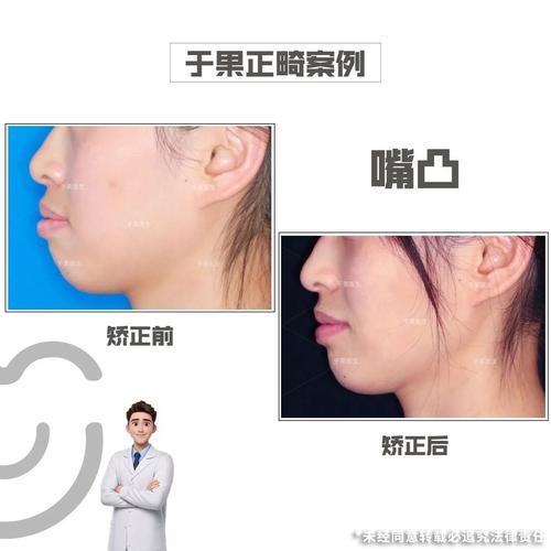 矫正牙齿能突嘴-图2