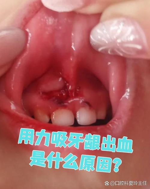 牙齿矫正后出血，是正常现象吗？该怎么处理？-图1
